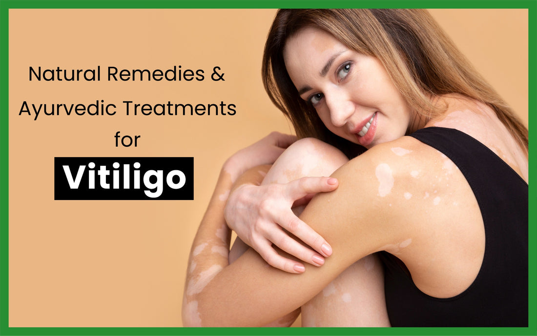 Natural Remedies and Ayurvedic Treatments for Vitiligo
