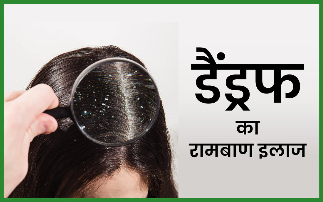 डैंड्रफ का रामबाण इलाज, डैंड्रफ का रामबाण इलाज oil, 1 दिन में डैंड्रफ कैसे हटाए, डैंड्रफ का घरेलू इलाज, डैंड्रफ होने का कारण, dandruff kyu hota hai