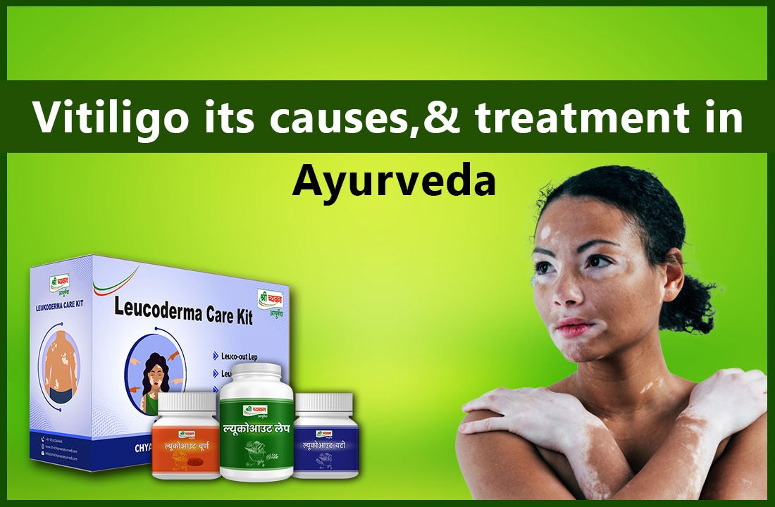 Leucoderma / Vitiligo Causes, Medicine & Treatment In Ayurveda