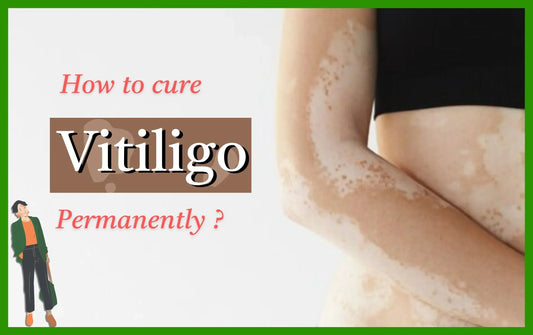 How to cure Vitiligo Permanently