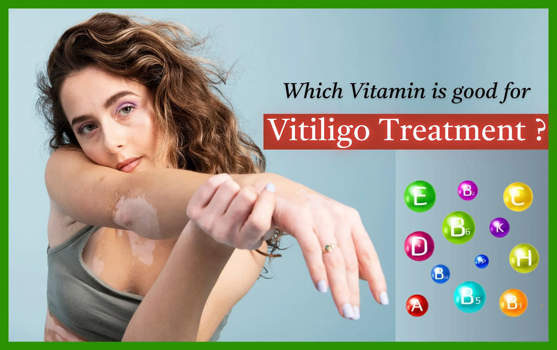 Which Vitamin is good for Vitiligo Treatment